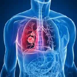 Cancer Pain Management in Surat