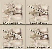 Spine Fracture Treatment Surat