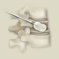 Kyphoplasty Treatment Surat