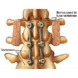 Post Surgical Pain